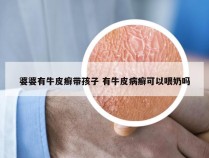 婆婆有牛皮癣带孩子 有牛皮病癣可以喂奶吗