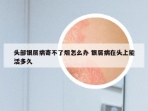 头部银屑病寄不了烟怎么办 银屑病在头上能活多久