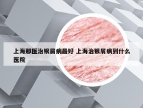 上海那医治银屑病最好 上海治银屑病到什么医院