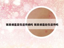 银屑病是显性遗传病吗 银屑病是隐性遗传吗