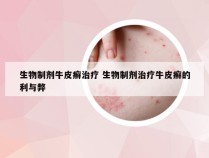 生物制剂牛皮癣治疗 生物制剂治疗牛皮癣的利与弊