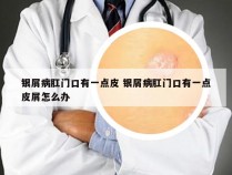 银屑病肛门口有一点皮 银屑病肛门口有一点皮屑怎么办