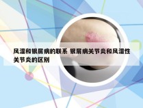 风湿和银屑病的联系 银屑病关节炎和风湿性关节炎的区别