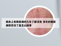 我身上有银屑病好几年了都没有 多年的银屑病突然没了是怎么回事