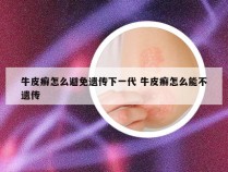 牛皮癣怎么避免遗传下一代 牛皮癣怎么能不遗传