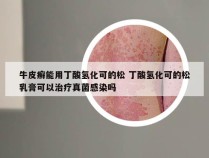 牛皮癣能用丁酸氢化可的松 丁酸氢化可的松乳膏可以治疗真菌感染吗
