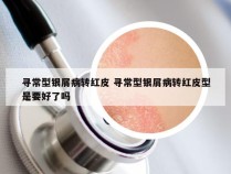 寻常型银屑病转红皮 寻常型银屑病转红皮型是要好了吗