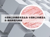 小孩身上长癣应该怎么办 小孩身上长癣怎么办 癣的种类与辨别