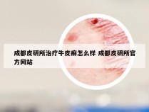成都皮研所治疗牛皮癣怎么样 成都皮研所官方网站