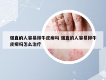 强直的人容易得牛皮癣吗 强直的人容易得牛皮癣吗怎么治疗
