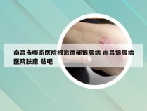 南昌市哪家医院根治面部银屑病 南昌银屑病医院肤康 贴吧