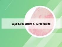 srpk1与银屑病关系 scc和银屑病