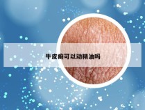 牛皮癣可以动精油吗