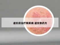 通玄府治疗银屑病 通玄散药方