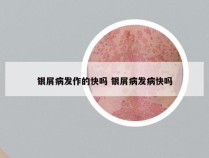 银屑病发作的快吗 银屑病发病快吗