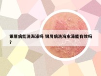 银屑病能洗海澡吗 银屑病洗海水澡能有效吗?
