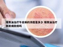 煤焦油治疗牛皮癣的浓度是多少 煤焦油治疗银屑病致癌吗