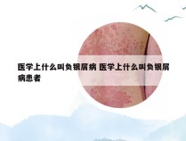 医学上什么叫负银屑病 医学上什么叫负银屑病患者