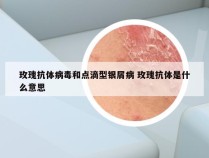 玫瑰抗体病毒和点滴型银屑病 玫瑰抗体是什么意思