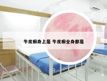 牛皮癣身上是 牛皮癣全身都是