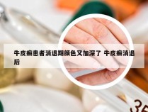 牛皮癣患者消退期颜色又加深了 牛皮癣消退后