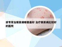 求专家治银屑病哪里最好 治疗银屑病比较好的医院
