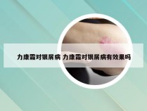 力康霜对银屑病 力康霜对银屑病有效果吗