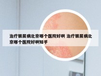 治疗银屑病北京哪个医院好啊 治疗银屑病北京哪个医院好啊知乎