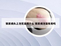 银屑病头上泡完澡摸什么 银屑病泡澡有用吗