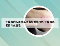 牛皮癣的人用什么洗衣服香味持久 牛皮癣患者用什么香皂