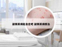 副银屑病能自愈吧 副银屑病根治