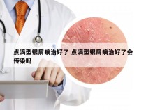 点滴型银屑病治好了 点滴型银屑病治好了会传染吗