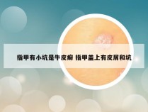 指甲有小坑是牛皮癣 指甲盖上有皮屑和坑