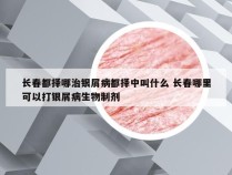 长春都择哪治银屑病都择中叫什么 长春哪里可以打银屑病生物制剂