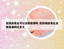 皮肤血毒丸可以治银屑病吗 皮肤病血毒丸治银屑病吗吃多久