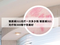 银屑病311光疗一次多少钱 银屑病311光疗和308哪个效果好