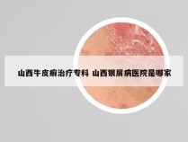 山西牛皮癣治疗专科 山西银屑病医院是哪家
