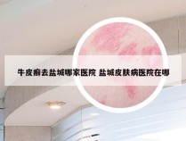 牛皮癣去盐城哪家医院 盐城皮肤病医院在哪