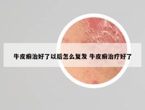 牛皮癣治好了以后怎么复发 牛皮癣治疗好了