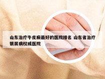 山东治疗牛皮癣最好的医院排名 山东省治疗银屑病权威医院