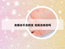 皮癣会不会脱皮 皮藓会掉皮吗