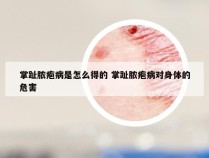 掌趾脓疱病是怎么得的 掌趾脓疱病对身体的危害