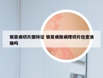 银屑病切片图特征 银屑病做病理切片检查准确吗