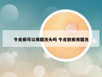 牛皮癣可以用醋洗头吗 牛皮肤癣用醋洗