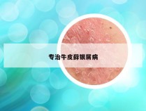 专治牛皮藓银屑病