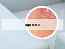 癣图 癣图片