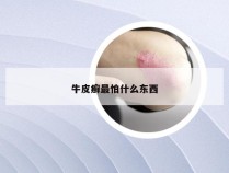 牛皮癣最怕什么东西