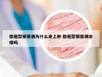 脓疱型银屑病为什么身上肿 脓疱型银屑病会痒吗