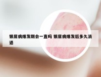 银屑病爆发期会一直吗 银屑病爆发后多久消退