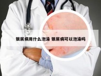 银屑病用什么泡澡 银屑病可以泡澡吗